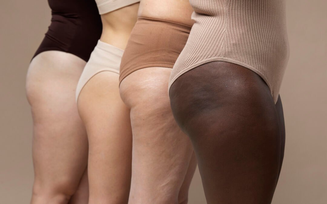 Cellulite: la differenza tra ritenzione idrica e adiposità localizzata
