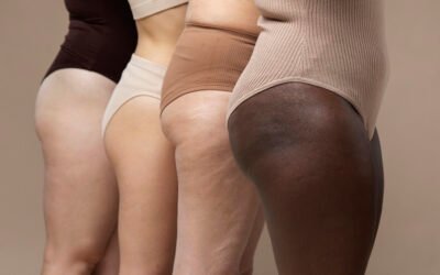 Cellulite: la differenza tra ritenzione idrica e adiposità localizzata