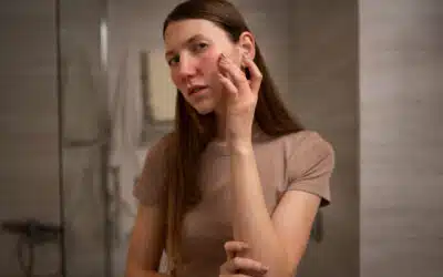 Rosacea e couperose: cause, sintomi e skincare lenitiva