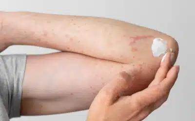 Cheratosi pilare sul corpo: cos’è, perché compare e come migliorare la grana della pelle con la skincare cosmetica