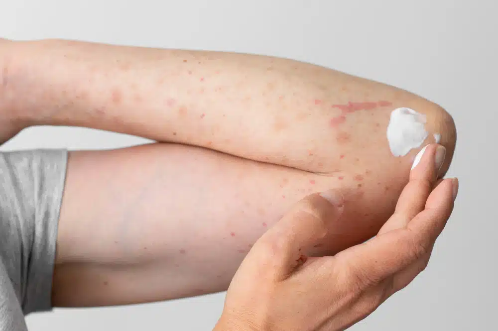 cheratosi pilare sul corpo