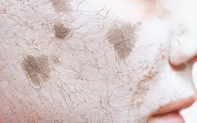 Barriera cutanea danneggiata: segnali e come ripararla