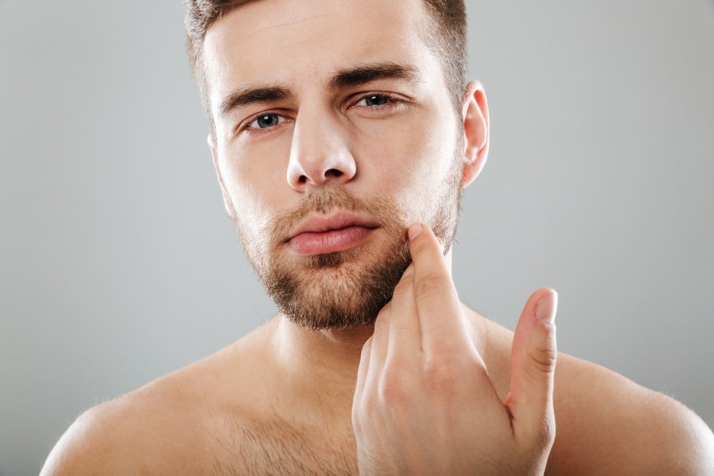 Pseudofollicolite della barba: perché si formano i peli incarniti dopo la rasatura